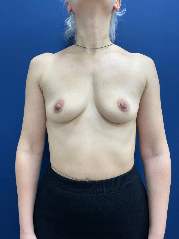 Увеличение грудных желез в Симферополе – фото 1