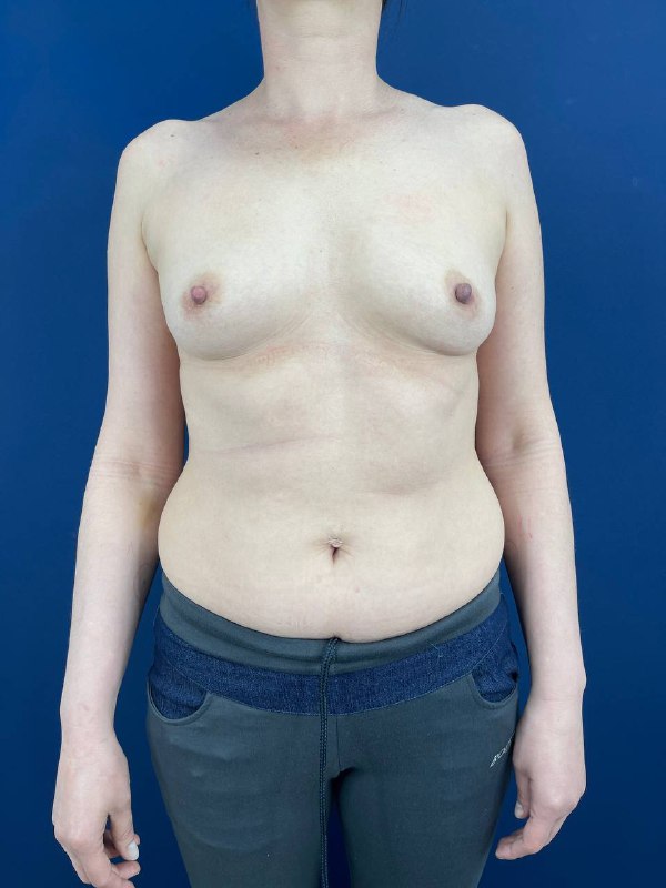 Увеличение груди в Симферополе – фото 1