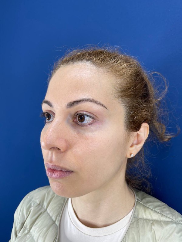 Липофилинг лица и блефаропластика в Симферополе – фото 18