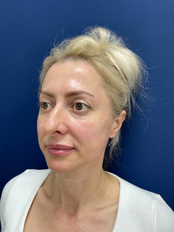 Липофилинг лица – отзывы в клинике пластической хирургии в Крыму