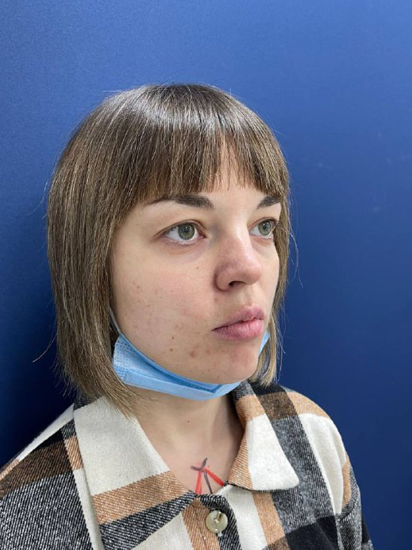 Цена операции на нависшем веке в Симферополе