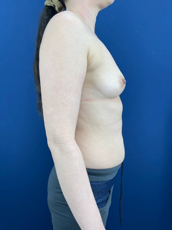 Увеличение груди в Симферополе – фото 7
