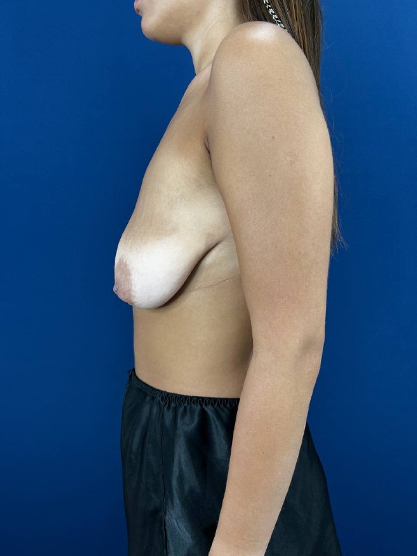 До и после операции по уменьшению груди