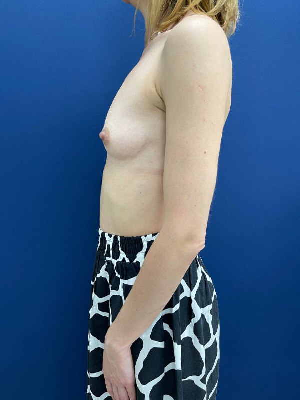 Увеличение грудных желез в Симферополе анатомическими имплантами
