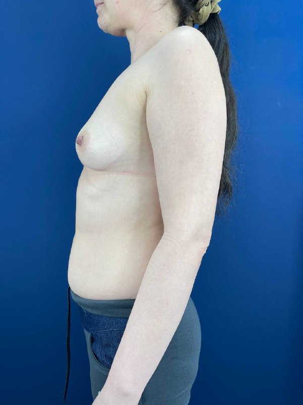 Увеличение груди в Симферополе – фото 9