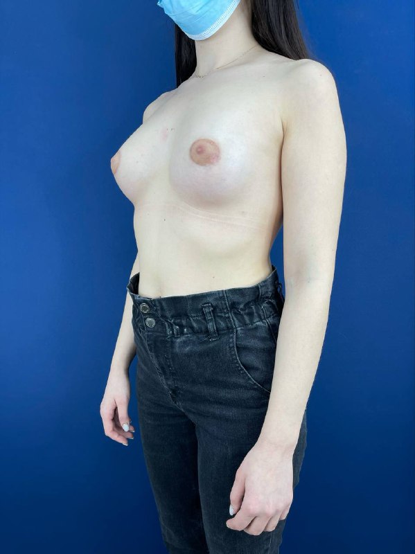 Увеличить грудь в Симферополе – фото 10