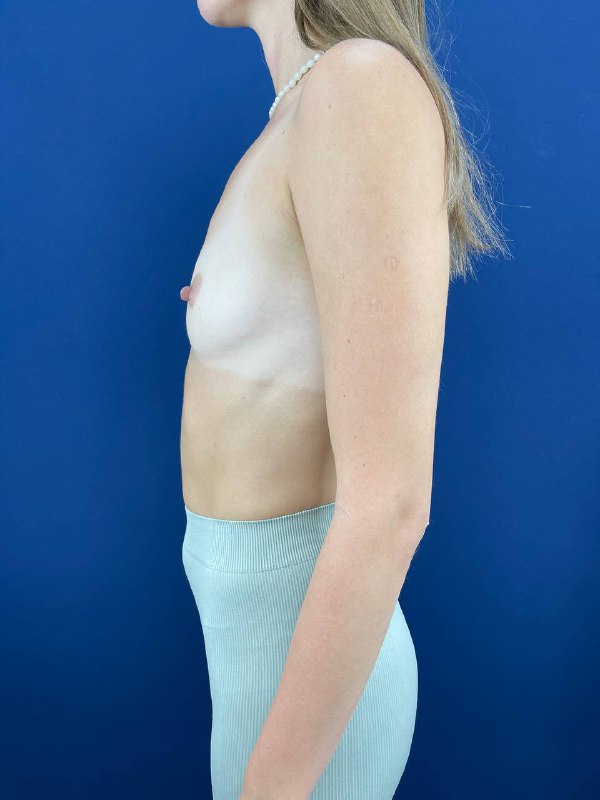 Фото и отзывы об операции по увеличению груди в Симферополе