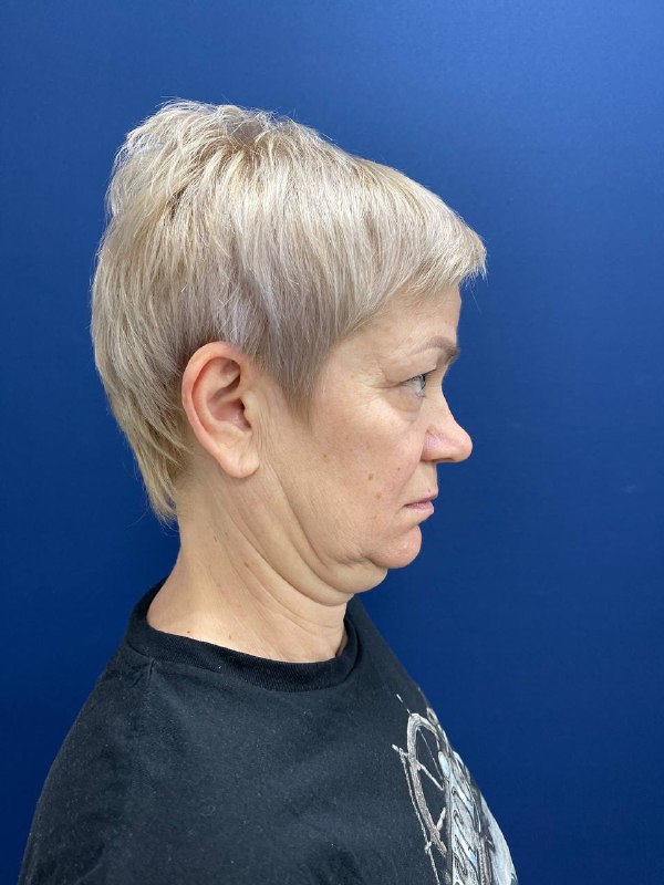 Подтяжка лица с верхней и нижней блефаропластикой – фото до после 11