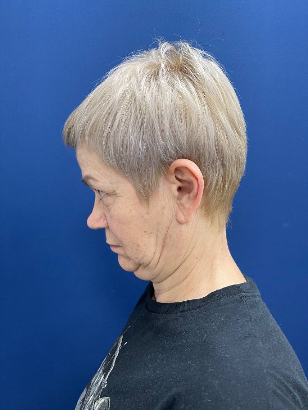 Подтяжка лица с верхней и нижней блефаропластикой – фото до после 15