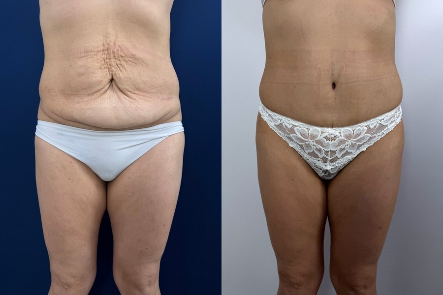 фото до после абдоминопластики