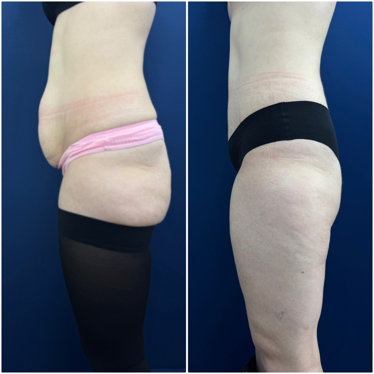 абдоминопластика живота операция