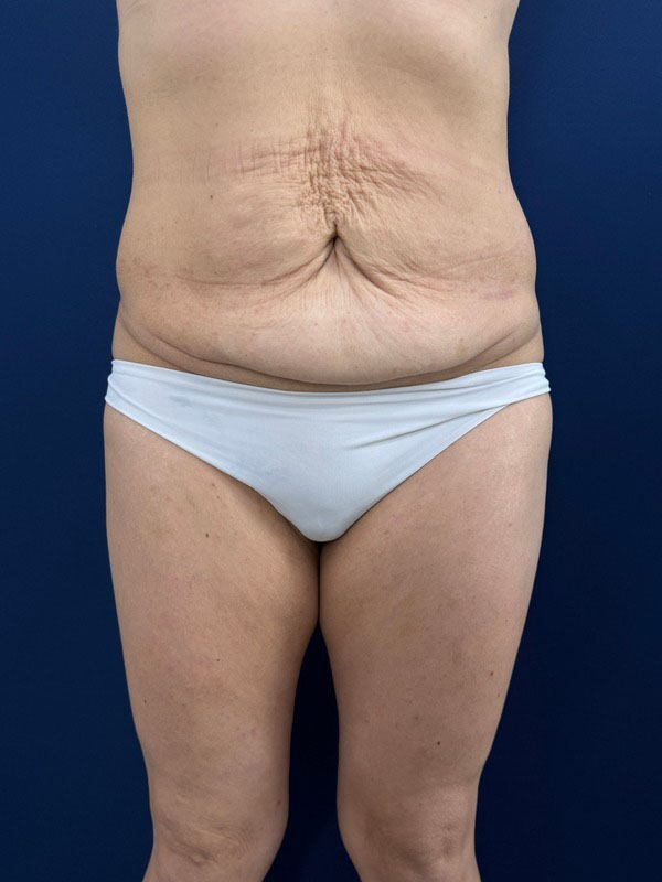 Операция СМАС-лифтинг