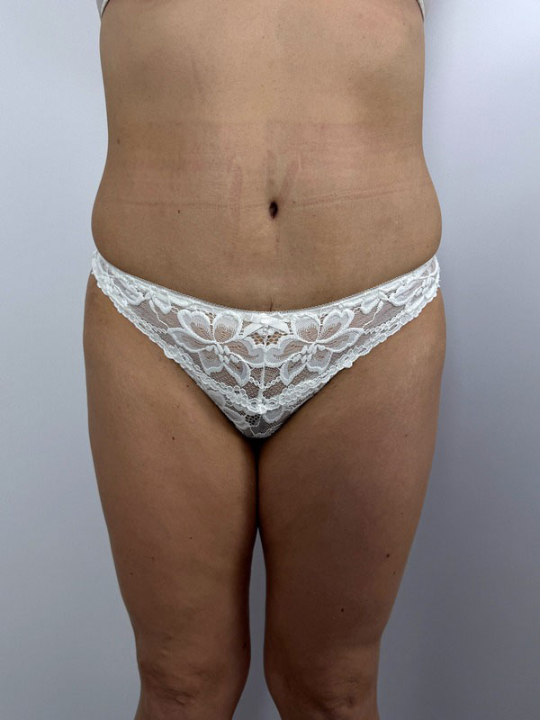 Отзывы об операции СМАС-лифтинг