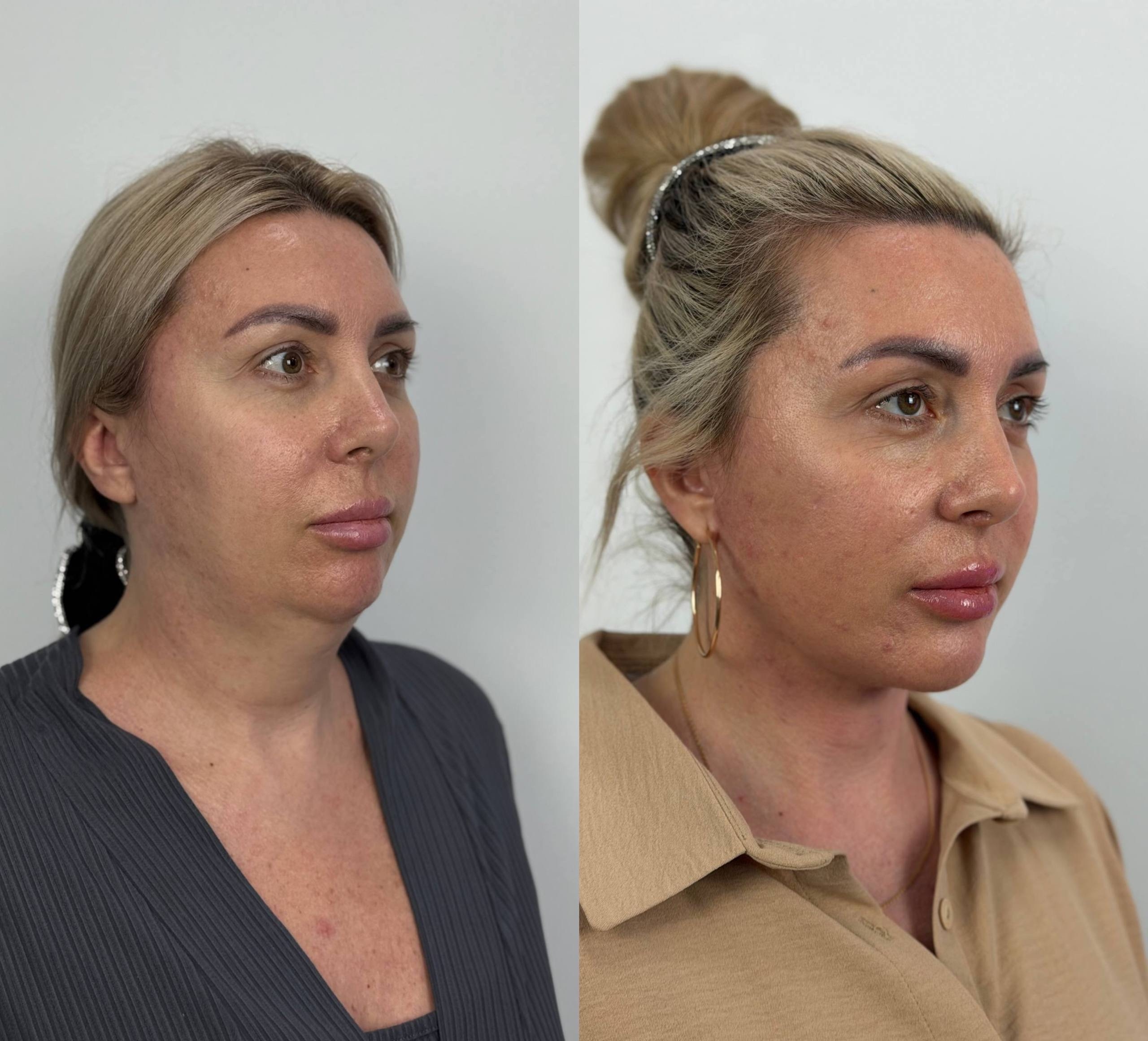 платизмопластика симферополь