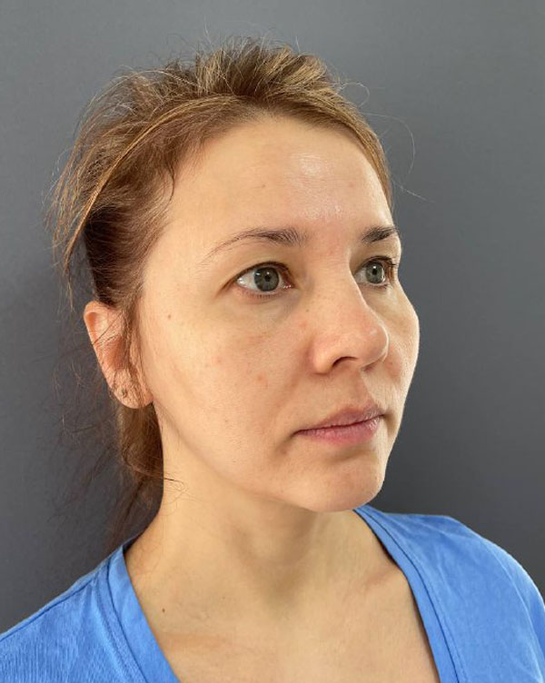  Круговая подтяжка лица в Симферополе цены