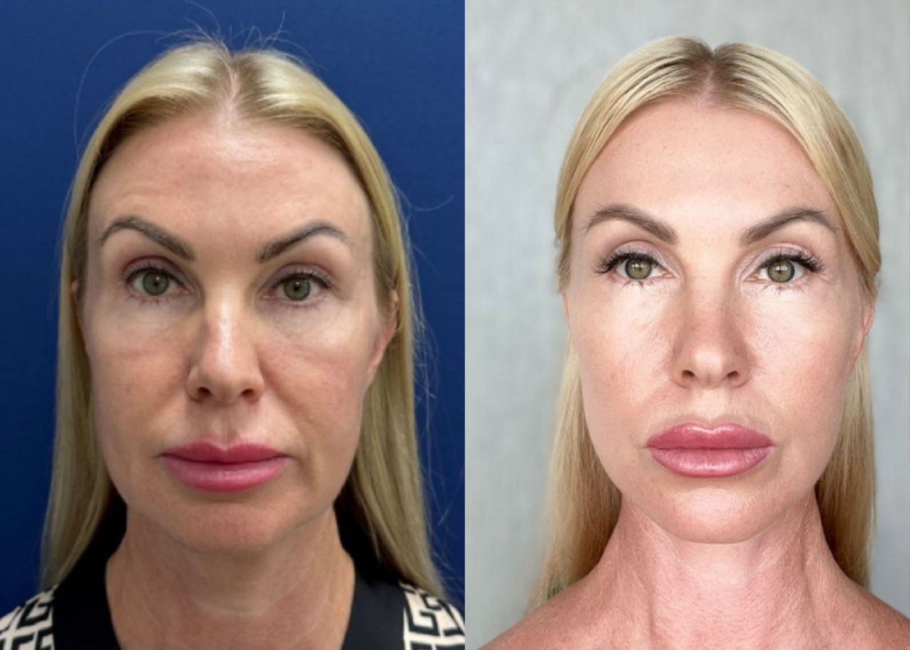 операция deep plane facelift