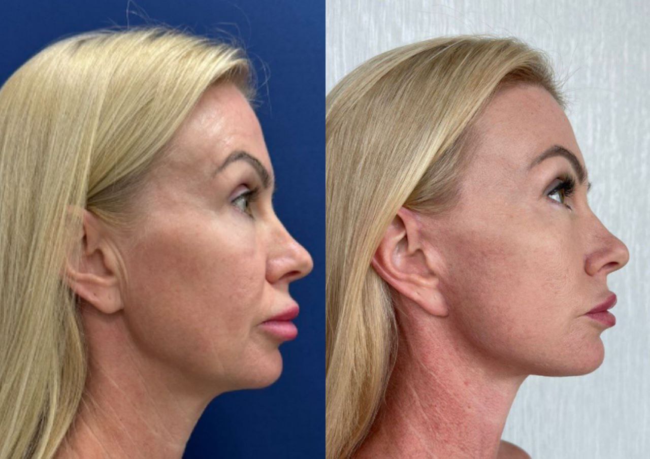 deep plane facelift отзывы