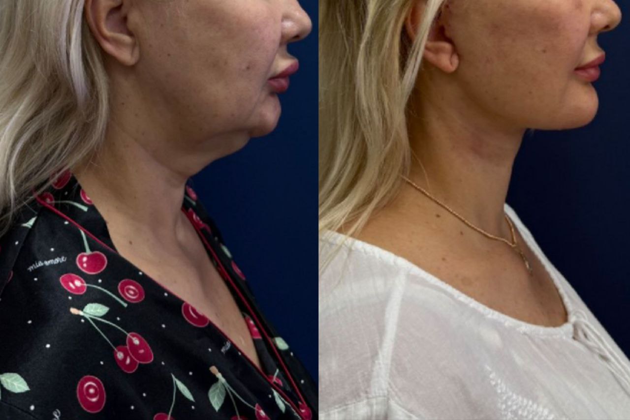 deep plane facelift отзывы реальных пациентов