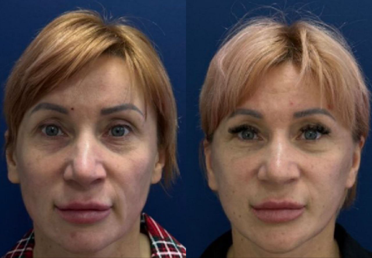 deep plane facelift