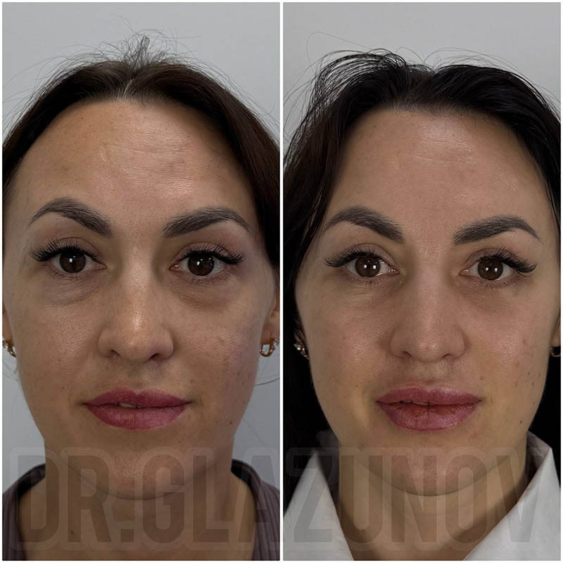 нижняя блефаропластика фото до и после отзывы