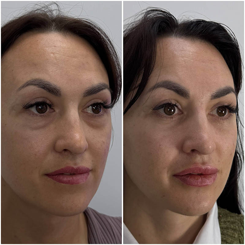 нижняя и верхняя блефаропластика фото