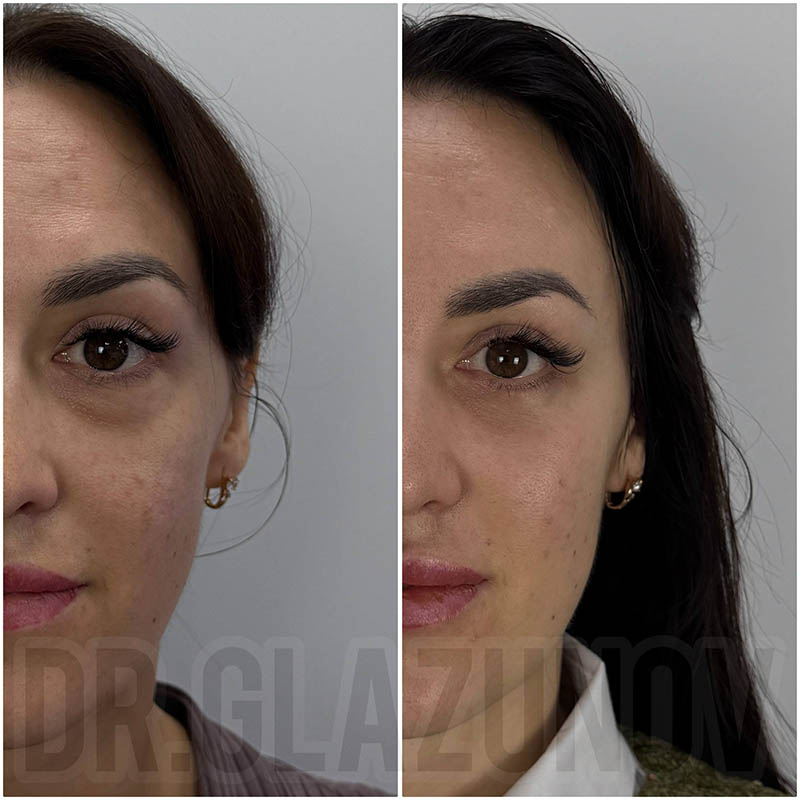 блефаропластика нижнего века отзывы фото