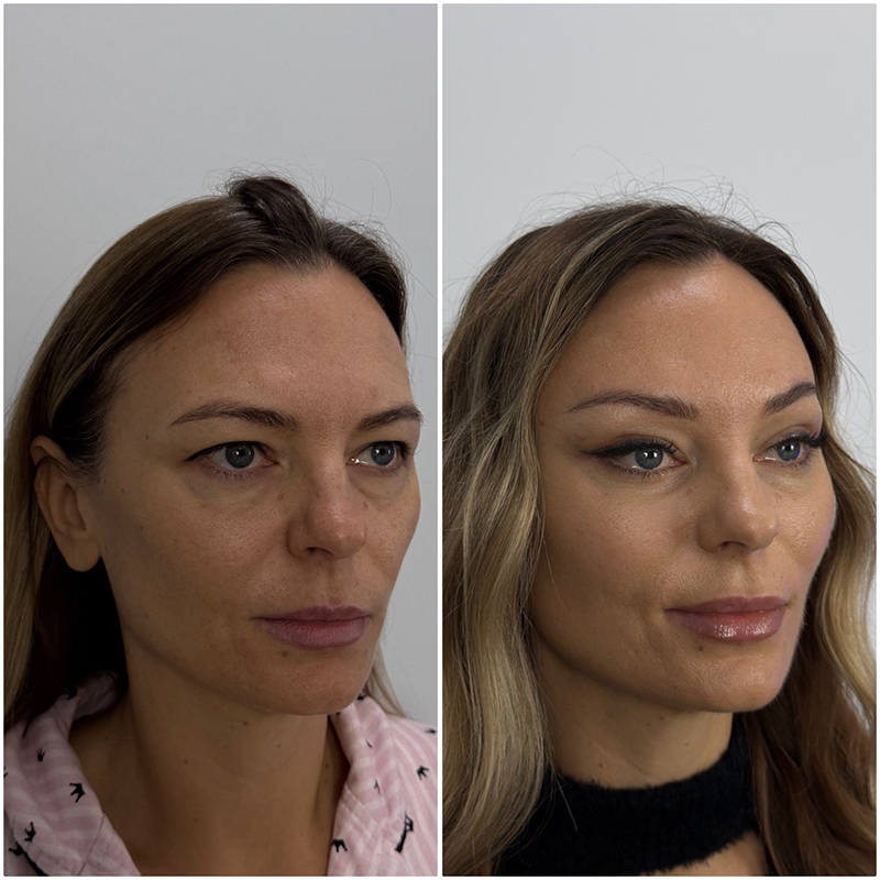 эндоскопическая подтяжка лица фото