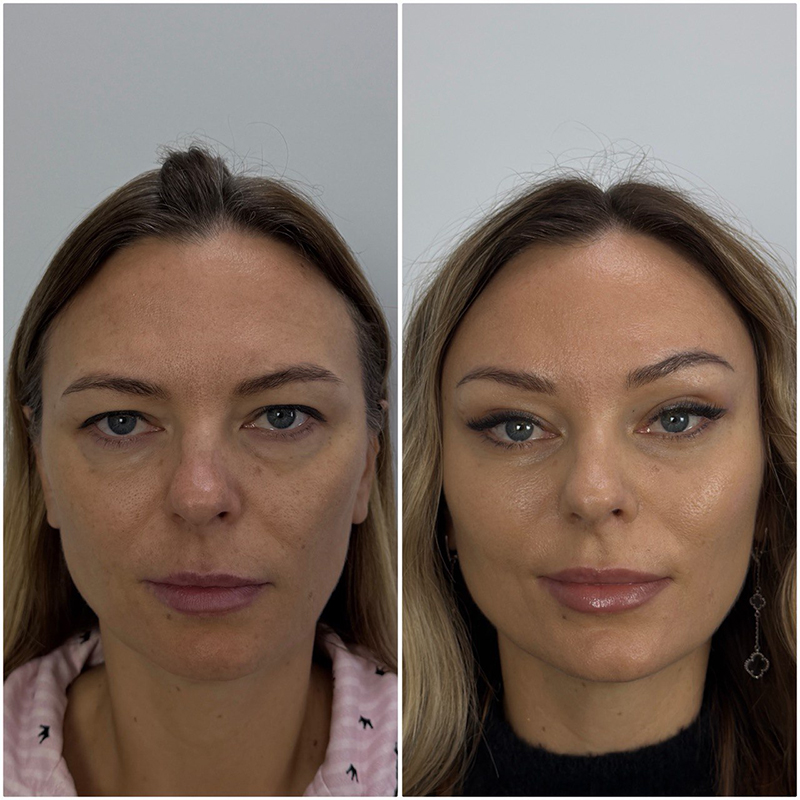 эндоскопическая подтяжка лица отзывы фото