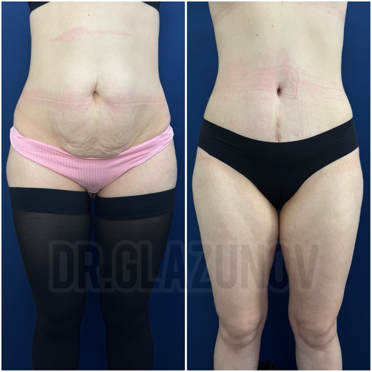 абдоминопластика живота