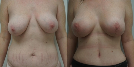 Увеличение груди до после – фото 18