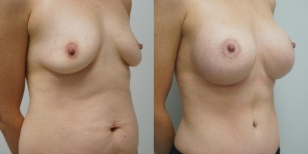 Увеличение груди до после – фото 17