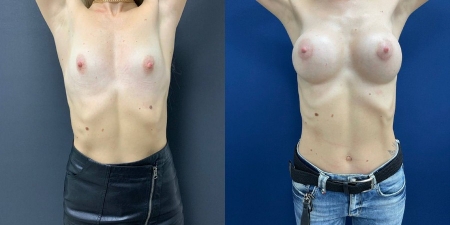 Увеличение груди до после – фото 15