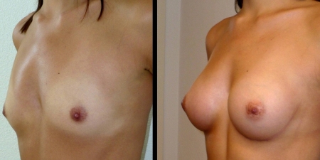 Увеличение груди до после – фото 26