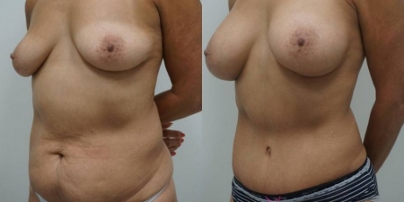 Увеличение груди до после – фото 7