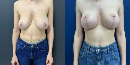 Увеличение груди до после – фото 8