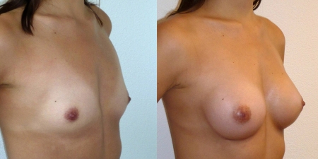 Увеличение груди до после – фото 59