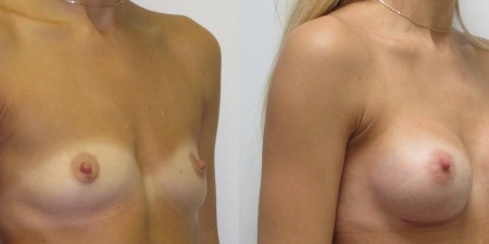 Увеличение груди до после – фото 21