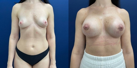Увеличение груди до после – фото 4