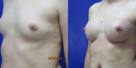 Увеличение груди до после – фото 32
