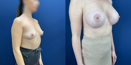 Увеличение груди до после – фото 5