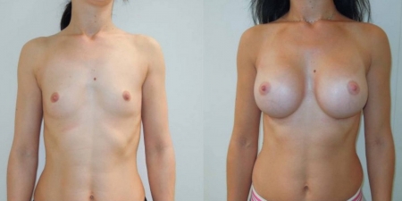 Увеличение груди до после – фото 22