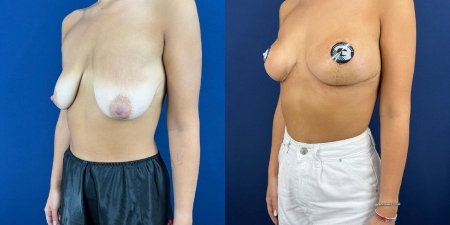 Увеличение груди до после – фото 65