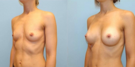 Увеличение груди до после – фото 61
