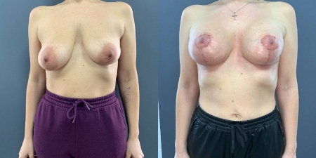 Увеличение груди до после – фото 16
