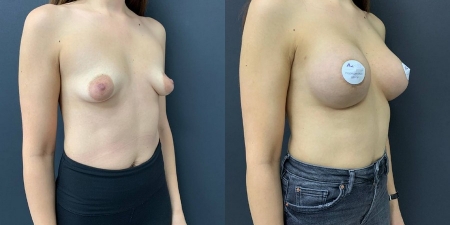 Увеличение груди до после – фото 11