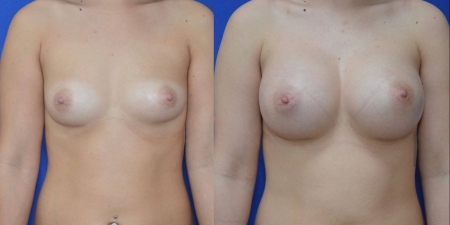 Увеличение груди до после – фото 24