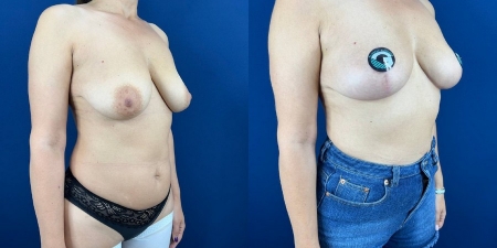 Увеличение груди до после – фото 70