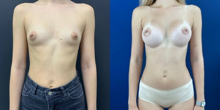 Увеличение груди до после – фото 12