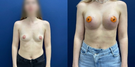 Увеличение груди до после – фото 3