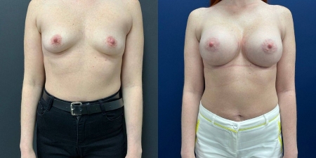 Увеличение груди до после – фото 9